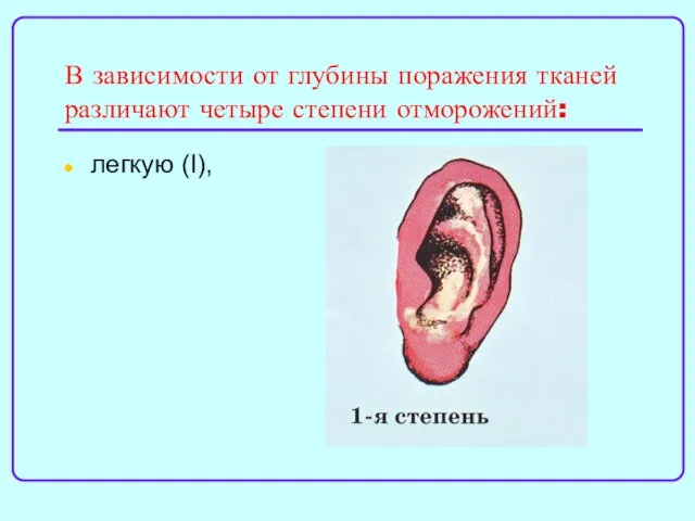 В зависимости от глубины поражения тканей различают четыре степени отморожений: легкую (I),