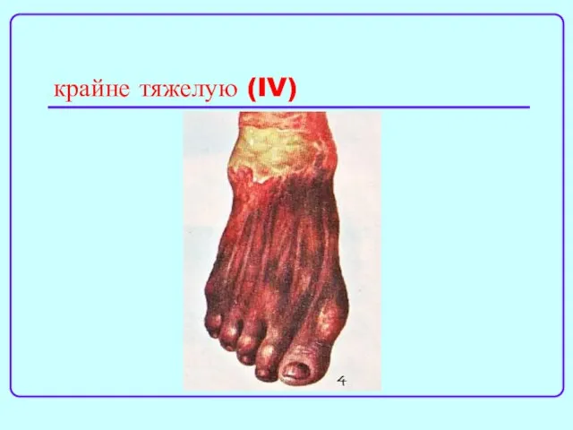 крайне тяжелую (IV)