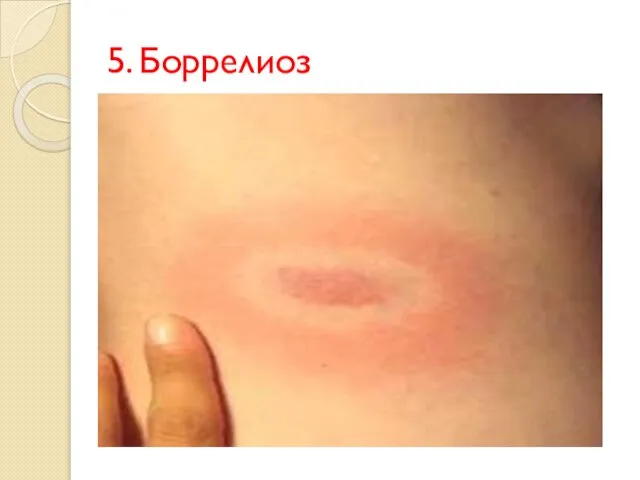 5. Боррелиоз