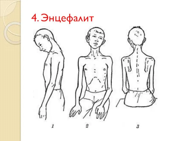 4. Энцефалит