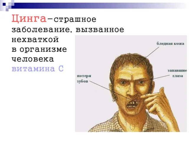 Цинга-страшное заболевание, вызванное нехваткой в организме человека витамина С