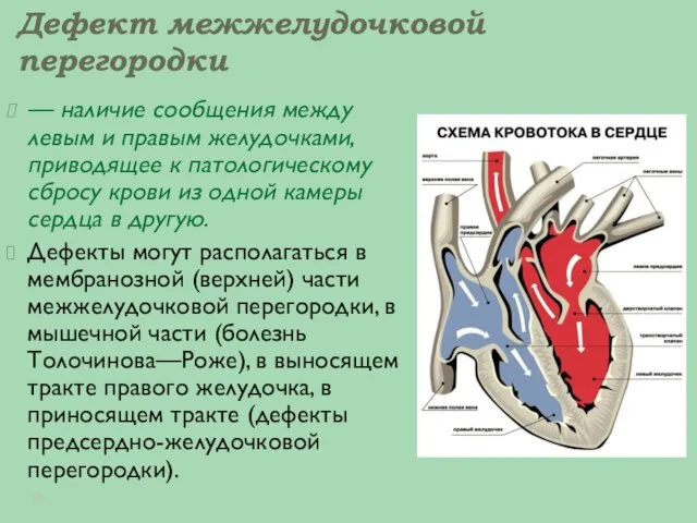 Дефект межжелудочковой перегородки — наличие сообщения между левым и правым желудочками, приводящее