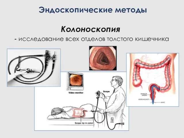 Колоноскопия - исследование всех отделов толстого кишечника Эндоскопические методы
