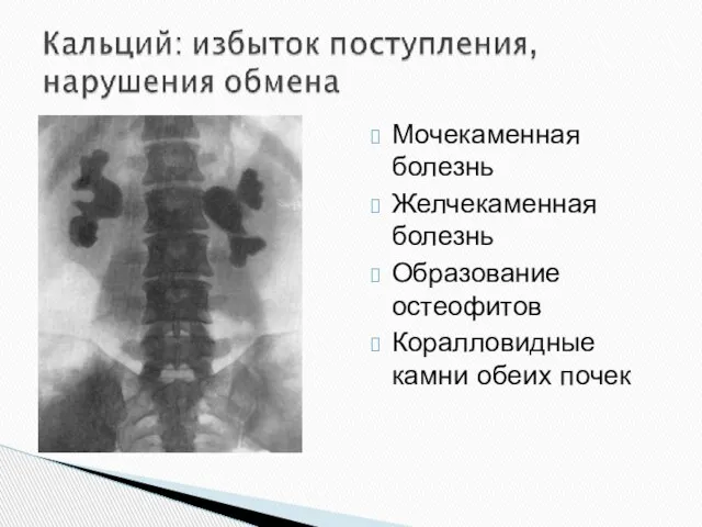 Мочекаменная болезнь Желчекаменная болезнь Образование остеофитов Коралловидные камни обеих почек