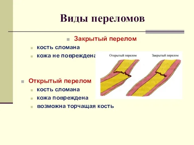 Виды переломов Закрытый перелом кость сломана кожа не повреждена Открытый перелом кость