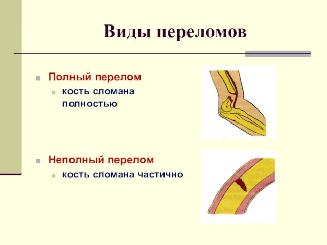 Виды переломов Полный перелом кость сломана полностью Неполный перелом кость сломана частично