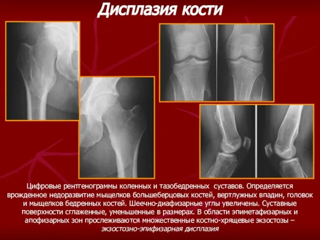 Цифровые рентгенограммы коленных и тазобедренных суставов. Определяется врожденное недоразвитие мыщелков большеберцовых костей,