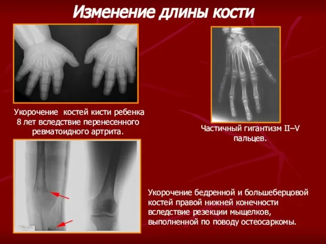 Частичный гигантизм II–V пальцев. Укорочение костей кисти ребенка 8 лет вследствие перенесенного