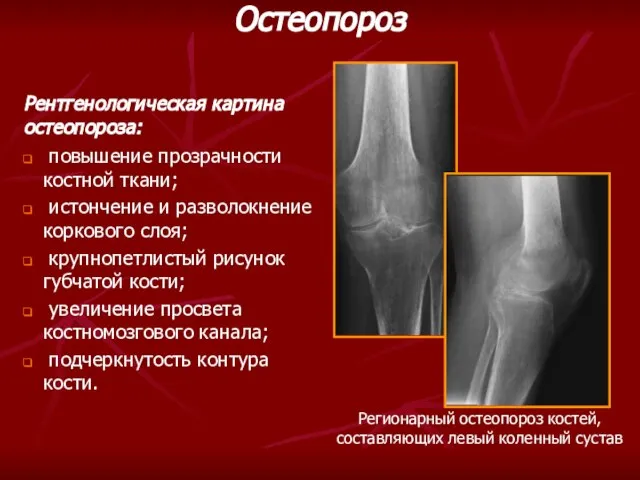 повышение прозрачности костной ткани; истончение и разволокнение коркового слоя; крупнопетлистый рисунок губчатой