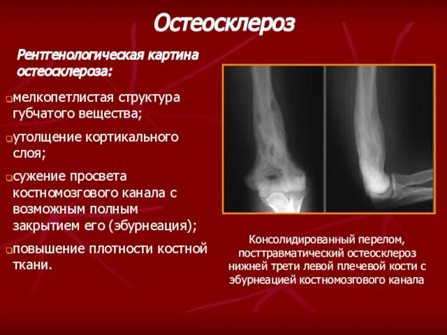 Рентгенологическая картина остеосклероза: мелкопетлистая структура губчатого вещества; утолщение кортикального слоя; сужение просвета