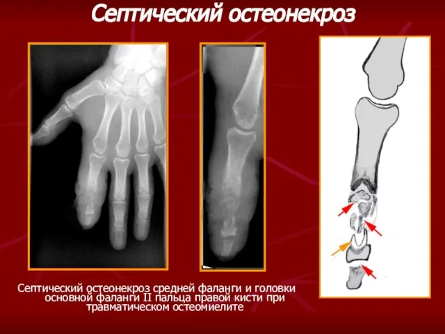 Септический остеонекроз Септический остеонекроз средней фаланги и головки основной фаланги II пальца