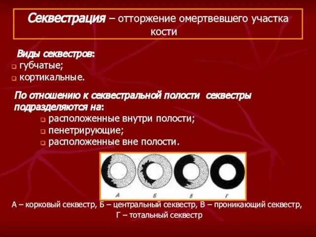 Виды секвестров: губчатые; кортикальные. Секвестрация – отторжение омертвевшего участка кости А –