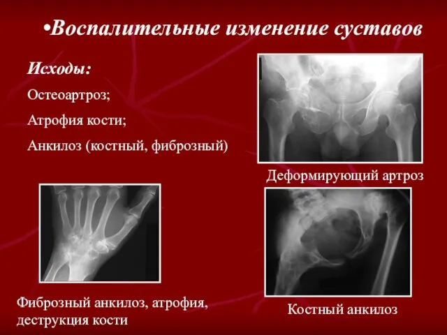 Воспалительные изменение суставов Исходы: Остеоартроз; Атрофия кости; Анкилоз (костный, фиброзный) Деформирующий артроз