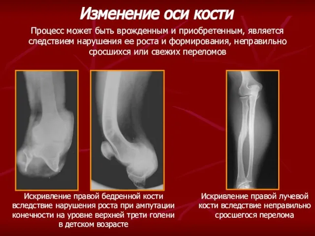 Искривление правой лучевой кости вследствие неправильно сросшегося перелома Изменение оси кости Процесс