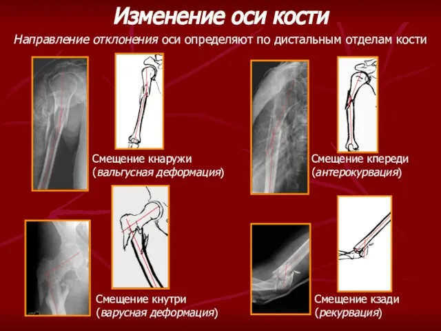 Изменение оси кости Направление отклонения оси определяют по дистальным отделам кости Смещение