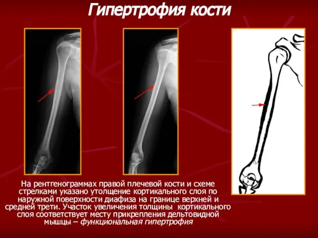 На рентгенограммах правой плечевой кости и схеме стрелками указано утолщение кортикального слоя