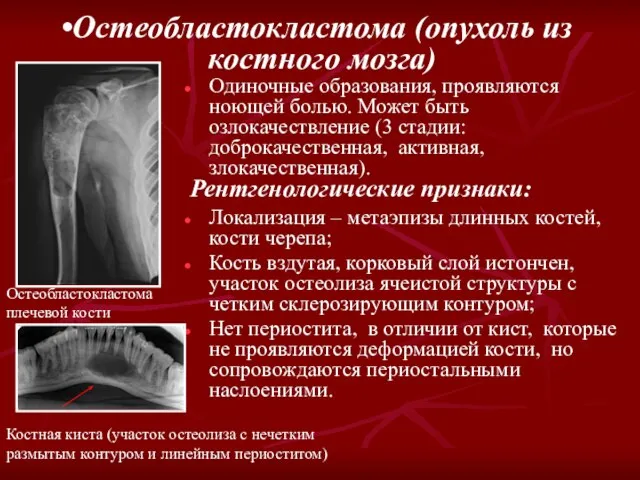Остеобластокластома (опухоль из костного мозга) Рентгенологические признаки: Одиночные образования, проявляются ноющей болью.