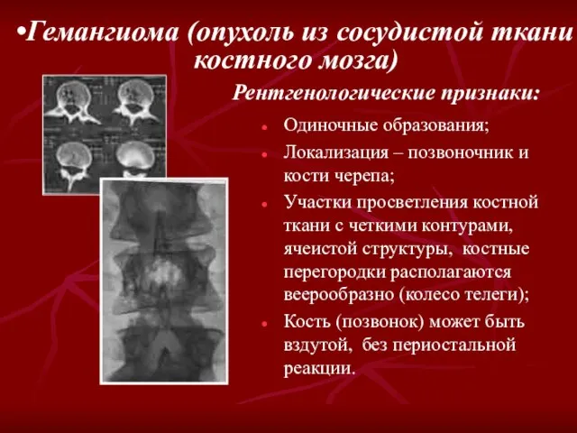 Гемангиома (опухоль из сосудистой ткани костного мозга) Рентгенологические признаки: Одиночные образования; Локализация