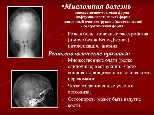 Миеломная болезнь Рентгенологические признаки: Резкая боль, почечные расстройства (в моче белок Бенс-Джонса),