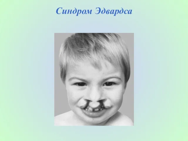 Синдром Эдвардса