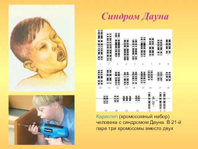 Синдром Дауна Кариотип (хромосомный набор) человека с синдромом Дауна. В 21-й паре три хромосомы вместо двух