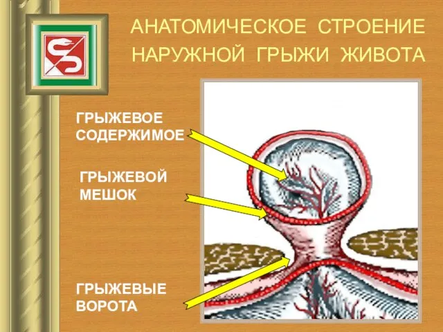 АНАТОМИЧЕСКОЕ СТРОЕНИЕ НАРУЖНОЙ ГРЫЖИ ЖИВОТА ГРЫЖЕВЫЕ ВОРОТА ГРЫЖЕВОЙ МЕШОК ГРЫЖЕВОЕ СОДЕРЖИМОЕ