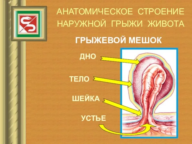 АНАТОМИЧЕСКОЕ СТРОЕНИЕ НАРУЖНОЙ ГРЫЖИ ЖИВОТА ГРЫЖЕВОЙ МЕШОК УСТЬЕ ШЕЙКА ТЕЛО ДНО