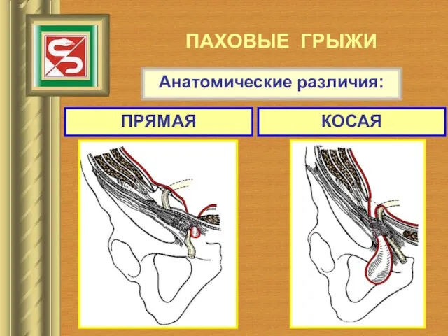 ПАХОВЫЕ ГРЫЖИ Анатомические различия: ПРЯМАЯ КОСАЯ