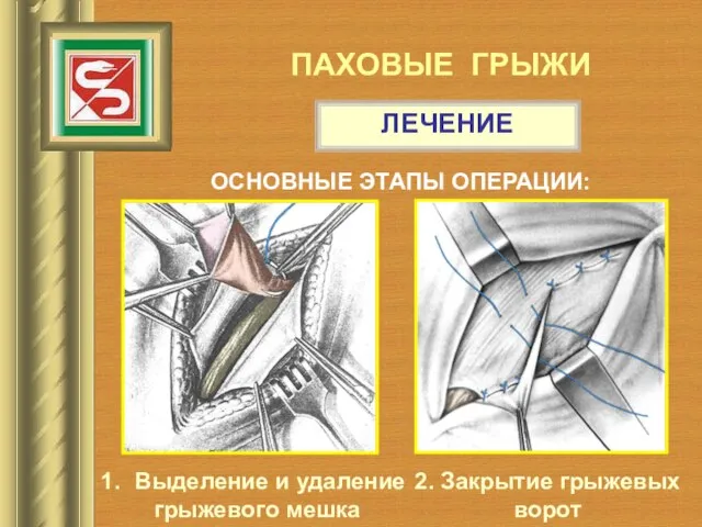 ПАХОВЫЕ ГРЫЖИ ЛЕЧЕНИЕ ОСНОВНЫЕ ЭТАПЫ ОПЕРАЦИИ: Выделение и удаление грыжевого мешка 2. Закрытие грыжевых ворот