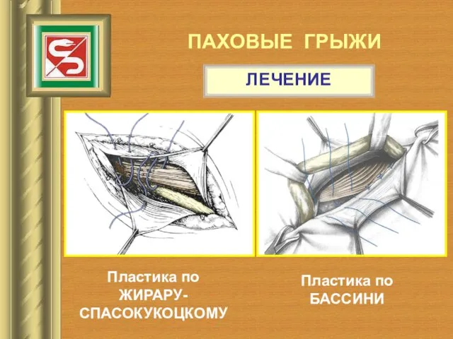 ПАХОВЫЕ ГРЫЖИ ЛЕЧЕНИЕ Пластика по ЖИРАРУ-СПАСОКУКОЦКОМУ Пластика по БАССИНИ