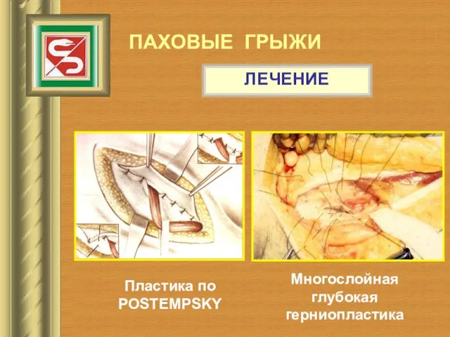 ПАХОВЫЕ ГРЫЖИ ЛЕЧЕНИЕ Многослойная глубокая герниопластика Пластика по POSTEMPSKY