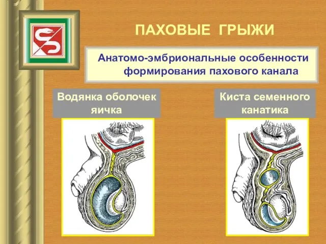 ПАХОВЫЕ ГРЫЖИ Анатомо-эмбриональные особенности формирования пахового канала Водянка оболочек яичка Киста семенного канатика