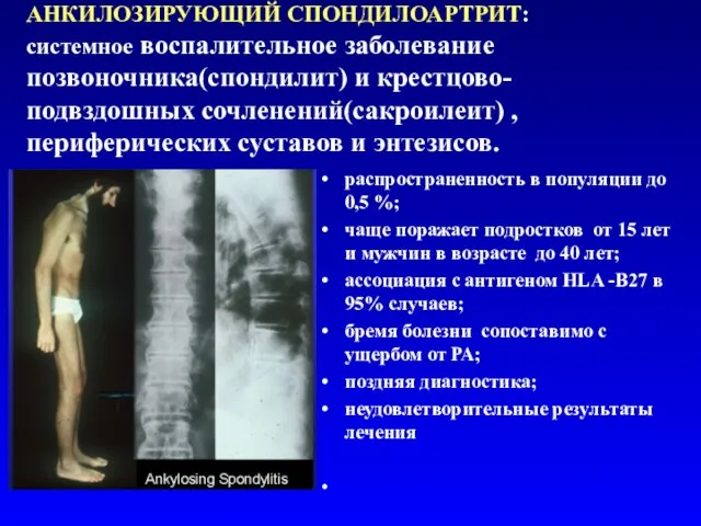 АНКИЛОЗИРУЮЩИЙ СПОНДИЛОАРТРИТ: системное воспалительное заболевание позвоночника(спондилит) и крестцово-подвздошных сочленений(сакроилеит) , периферических суставов