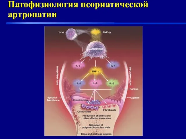 Патофизиология псориатической артропатии