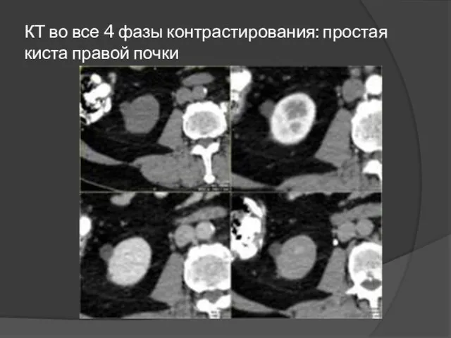 КТ во все 4 фазы контрастирования: простая киста правой почки