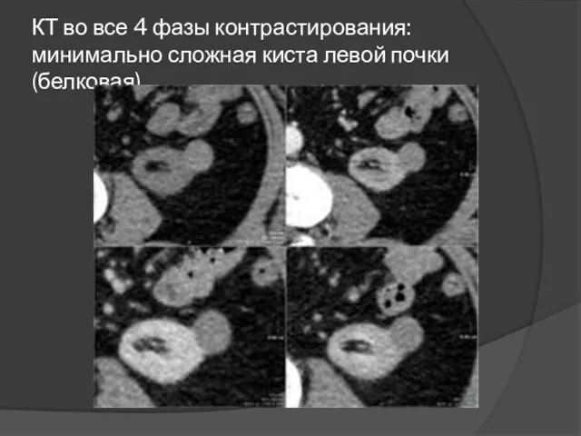 КТ во все 4 фазы контрастирования: минимально сложная киста левой почки (белковая)