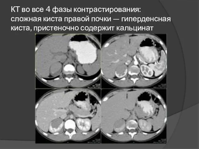 КТ во все 4 фазы контрастирования: сложная киста правой почки — гиперденсная киста, пристеночно содержит кальцинат