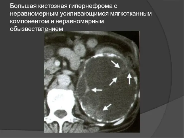 Большая кистозная гипернефрома с неравномерным усиливающимся мягкотканным компонентом и неравномерным обызвествлением