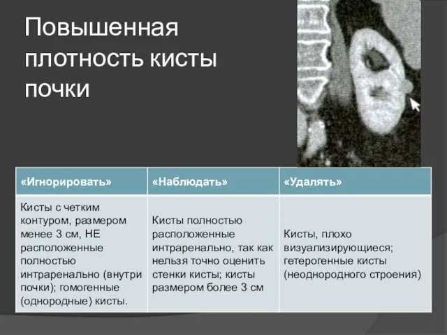 Повышенная плотность кисты почки