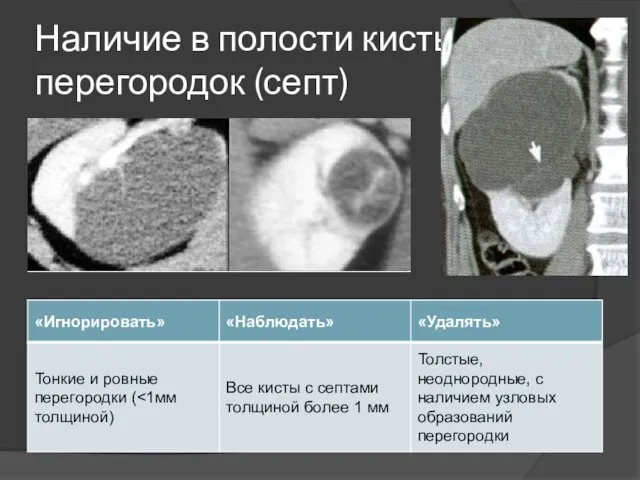 Наличие в полости кисты перегородок (септ)