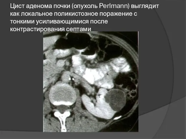 Цист аденома почки (опухоль Perlmann) выглядит как локальное поликистозное поражение с тонкими усиливающимися после контрастирования септами