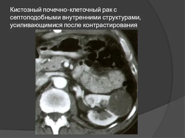 Кистозный почечно-клеточный рак с септоподобными внутренними структурами, усиливающимися после контрастирования