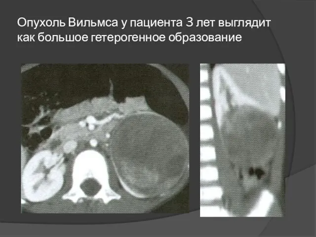 Опухоль Вильмса у пациента 3 лет выглядит как большое гетерогенное образование