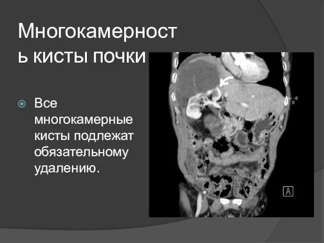 Многокамерность кисты почки Все многокамерные кисты подлежат обязательному удалению.