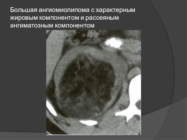 Большая ангиомиолипома с характерным жировым компонентом и рассеяным ангиматозным компонентом