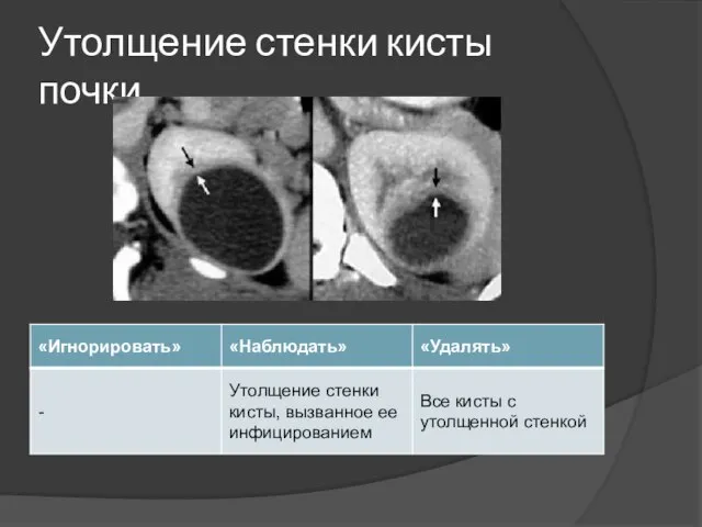 Утолщение стенки кисты почки