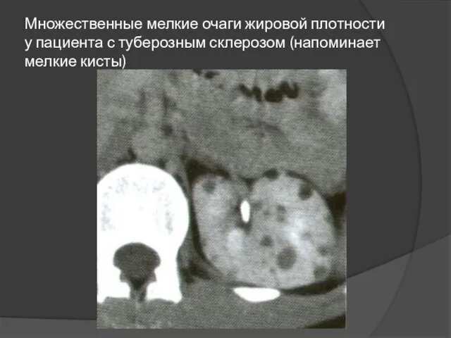 Множественные мелкие очаги жировой плотности у пациента с туберозным склерозом (напоминает мелкие кисты)