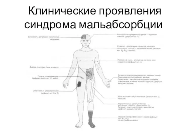 Клинические проявления синдрома мальабсорбции