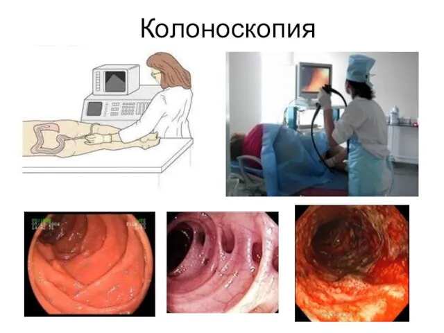 Колоноскопия