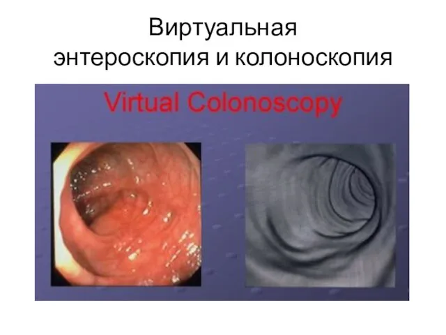 Виртуальная энтероскопия и колоноскопия